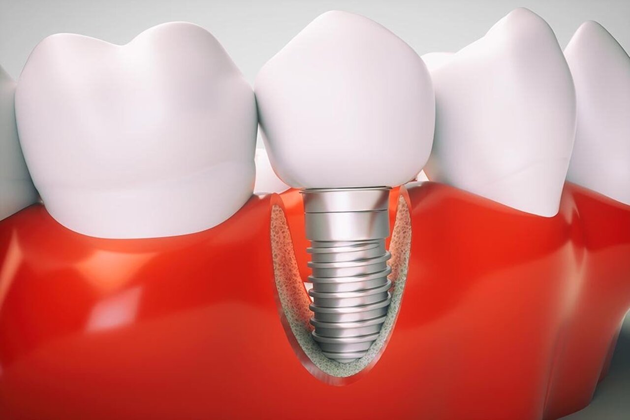 what is dental implant ?&nbsp;