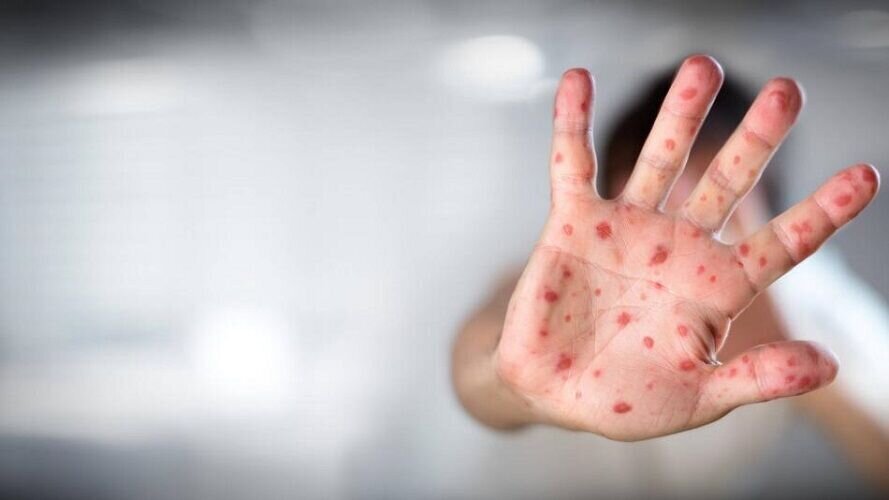 Iran reports first case of monkeypox