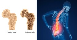 Osteoporosis: today's common hidden disease  By Faranak Bakhtiari    TEHRAN – Every year, osteoporosis causes more than 170,000 fractures and about 4,200 deaths among Iranians, which is the most commo