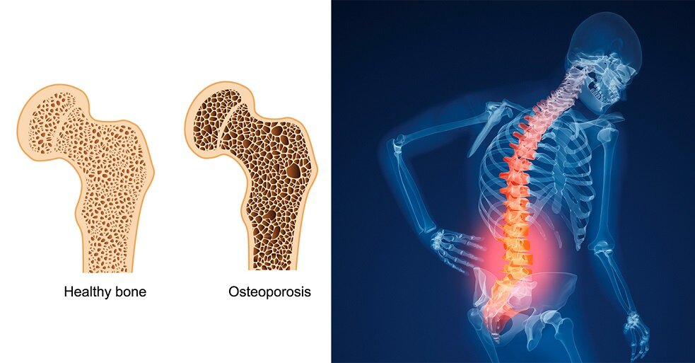 Osteoporosis: today's common hidden disease By Faranak Bakhtiari TEHRAN – Every year, osteoporosis causes more than 170,000 fractures and about 4,200 deaths among Iranians, which is the most commo