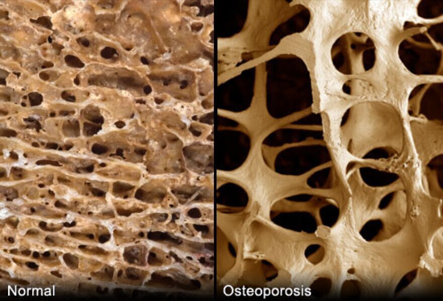 46% of Iranian women, 28% of men suffering from osteoporosis