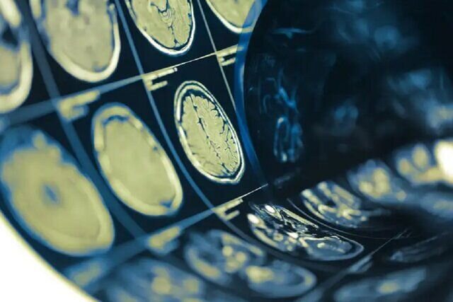 Stroke is second leading cause of death in Iran: official
