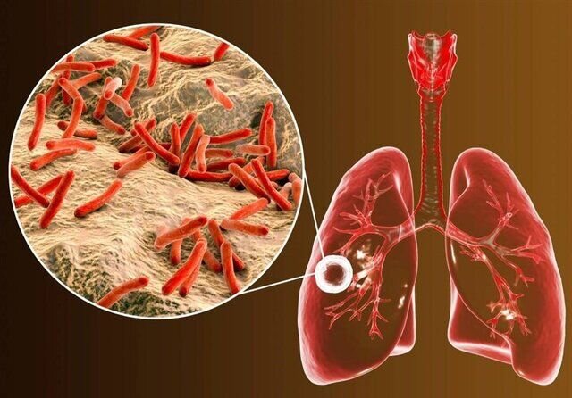 Afghan nationals being screened for tuberculosis