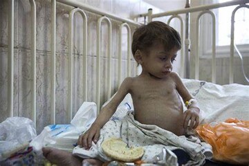 Children die of malnutrition in Gaza