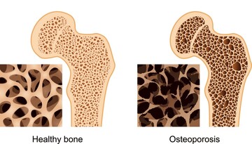 Osteoporosis screening program underway