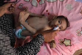 Starvation among Gaza children