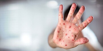 WHO verifies Iran's elimination of measles, rubella in 2023