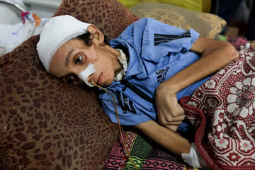 Malnourished Child in Gaza