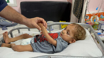 Gaza malnutrition