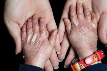 Health insurance provided for some 2m patients with rare, hard-to-treat diseases