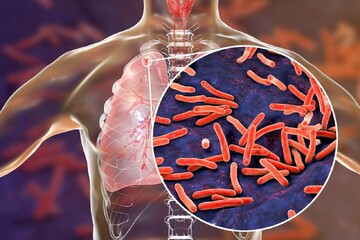 Iran makes progress in tuberculosis control, but gaps in case detection remain